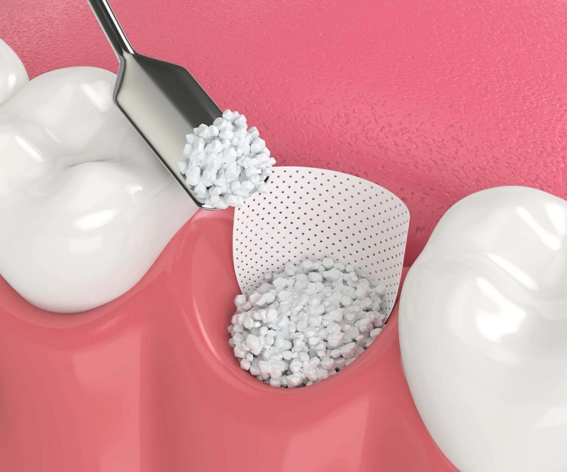 Bone Grafting