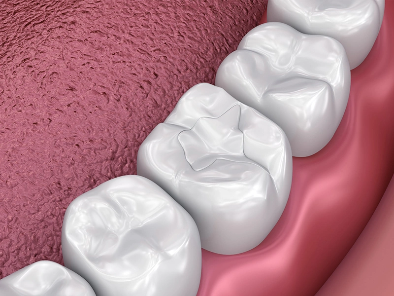 Composite Fillings