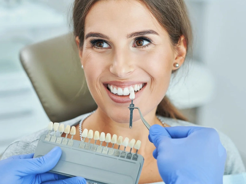 Veneers