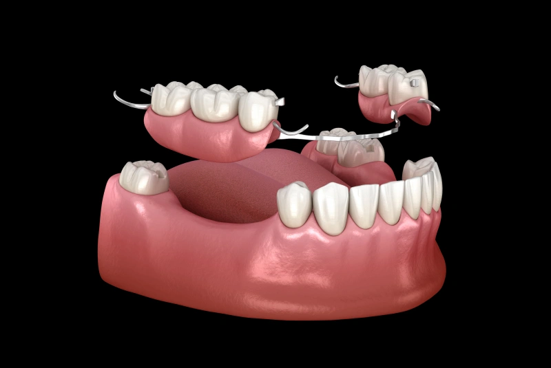 Dental Bridges treatment Benefits - Dental Bridges in The Woodlands, TX