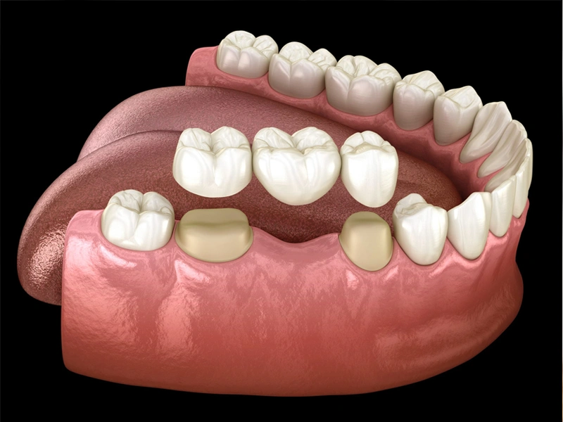 Dental Bridges treatment at The Woodlands Dentistry and Orthodontics in The Woodlands, TX