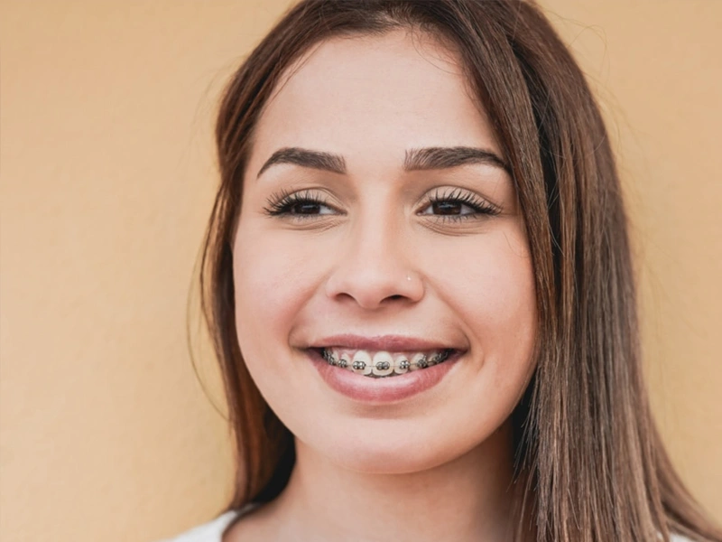 Traditional Metal Braces in The Woodlands, TX