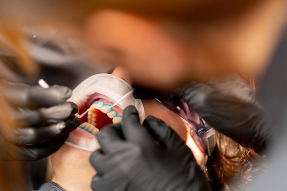 Your Complete Guide to Teeth Whitening: Options, Costs, and Results