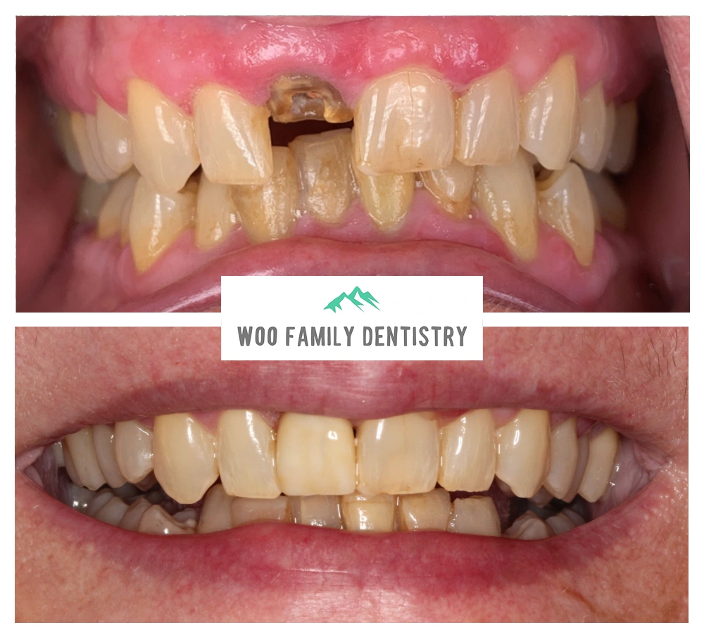 Tooth replacement with dental implants