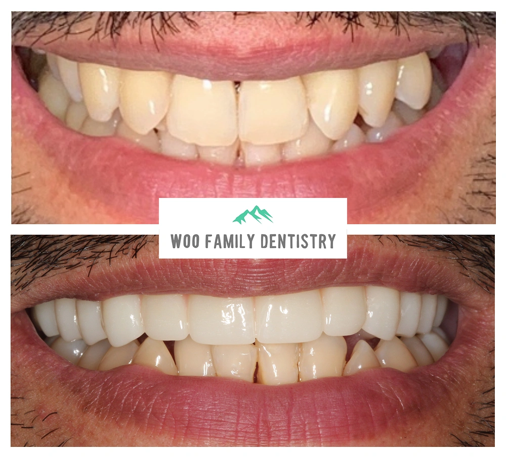 Dental implant tooth replacement therapy procedure at Woo Family Dentistry