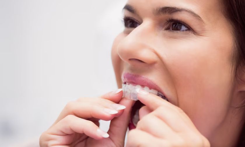 Straighten Your Teeth Without Braces