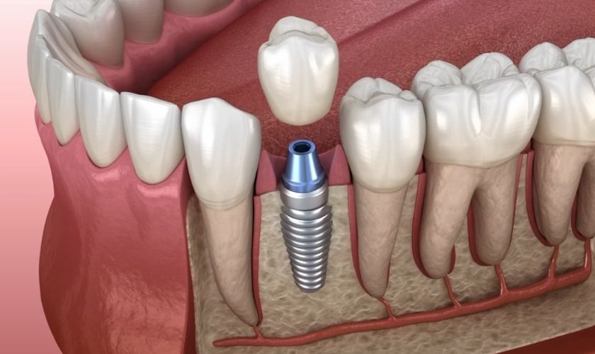 What Are The 3 Stages Of Dental Implant