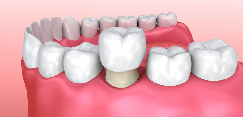What To Do When Your Dental Crowns Break