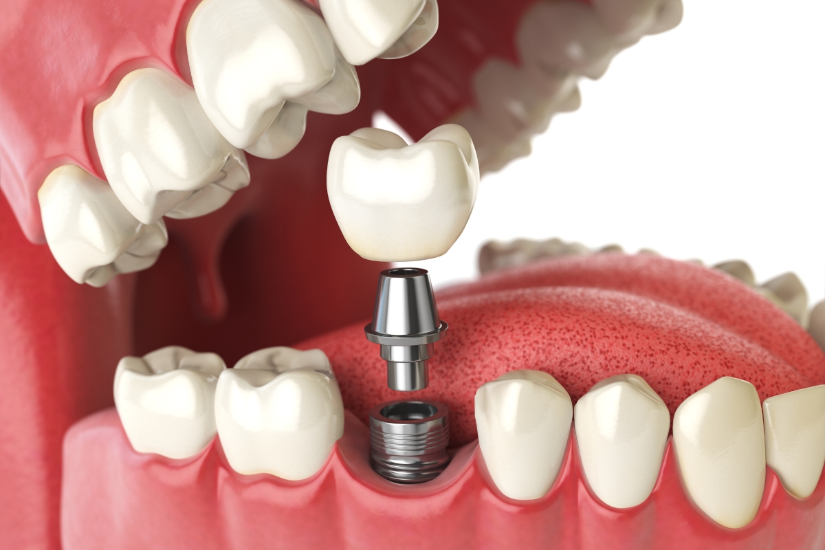 dental implants in Aurora