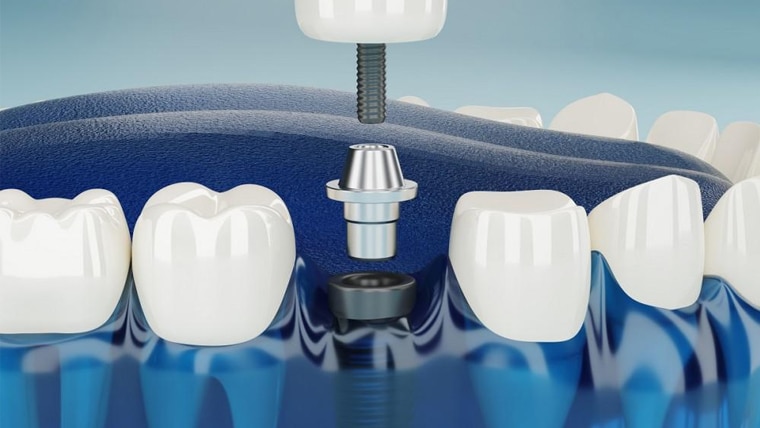 What Is A Dental Implant? 1 Dental Implant upland