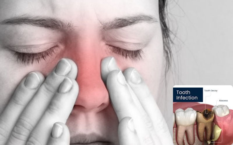 Can Root Canal Therapy Improve Sinus Infections? 1 Tooth Infection Causes Sinus