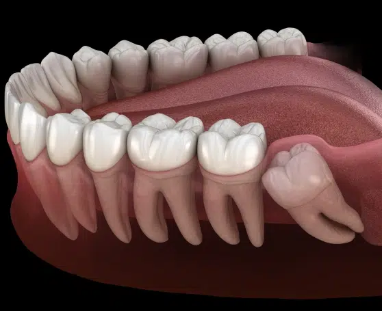 Wisdom Teeth Removal 1 Image