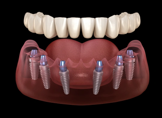 img-all-on-x-implants